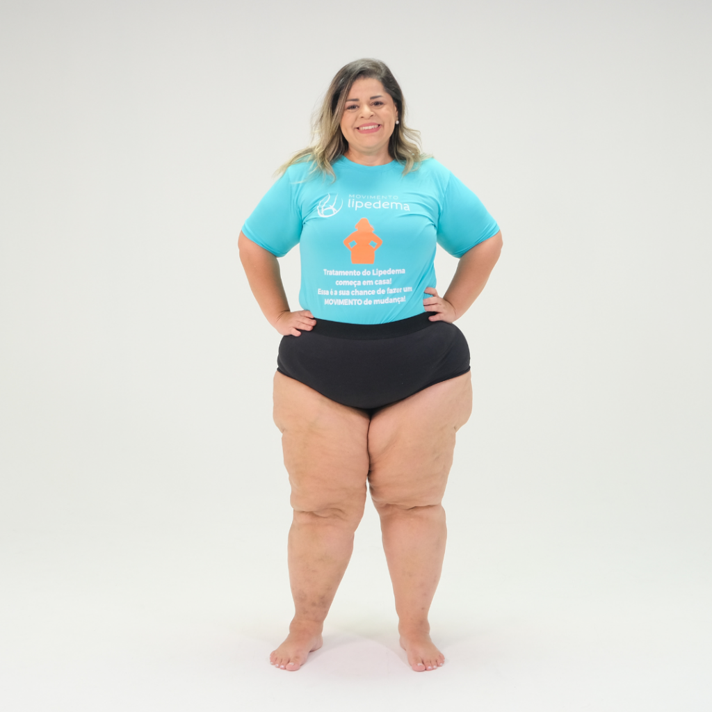 Causas del lipedema