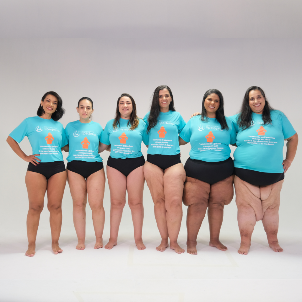 Lipedema en mujeres